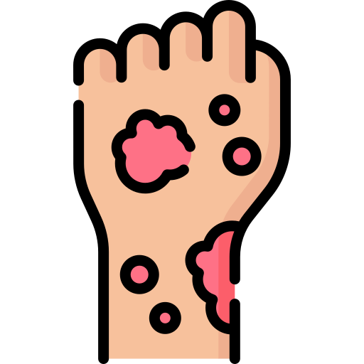 Eczema