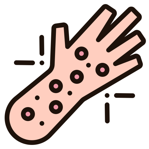 Urticaria