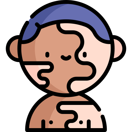 Vitiligo