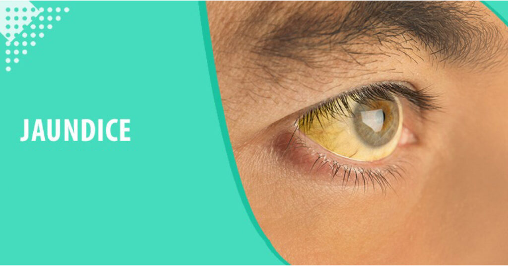 Jaundice – Yellowish Tinge to the Skin