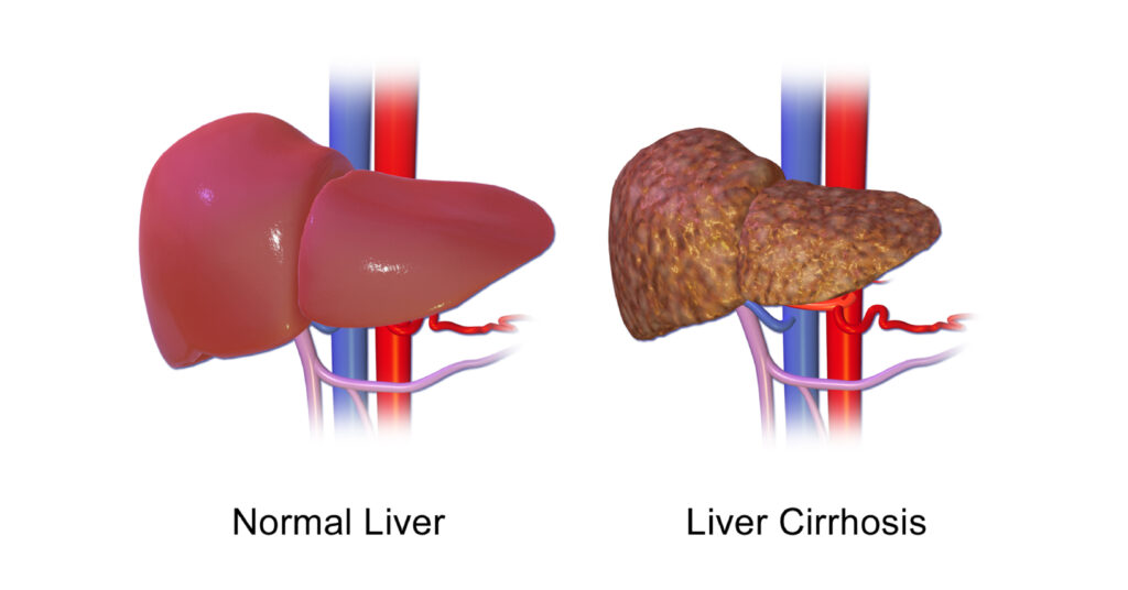 Liver Cirrhosis – A late-stage liver disease
