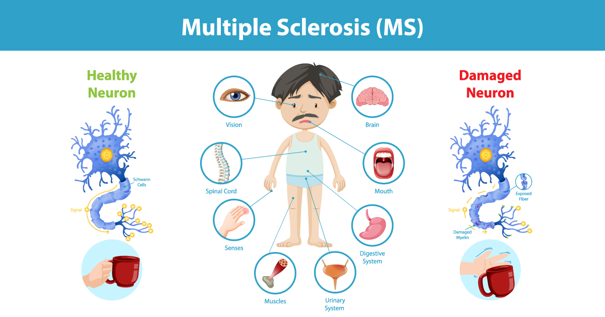 Multiple Sclerosis Causes Signs And Ayurvedic Treatment