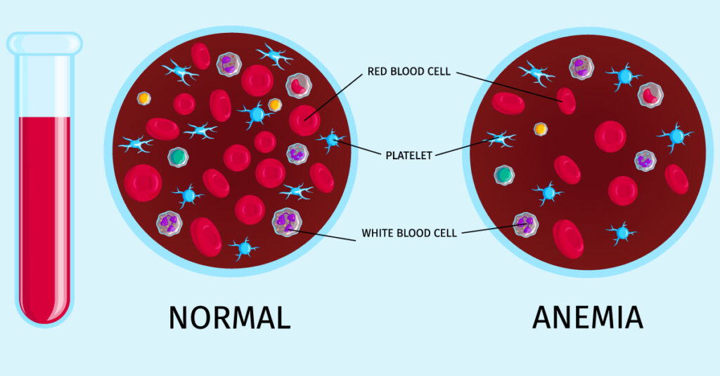 Anemia – A nutritional deficiency disorder