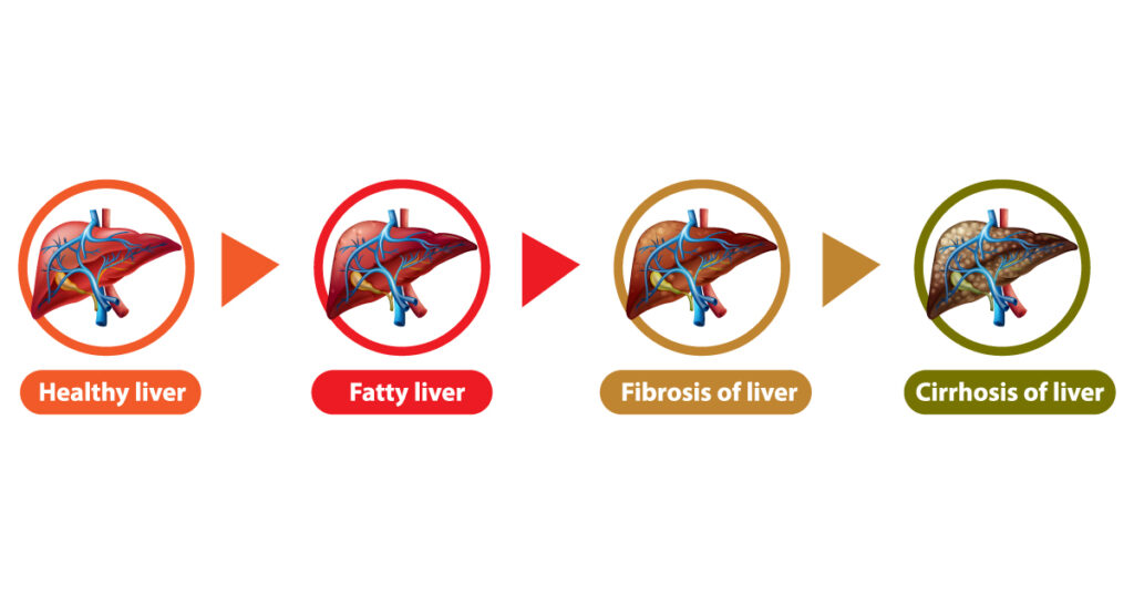 Fatty Liver: Fat accumulation in the liver