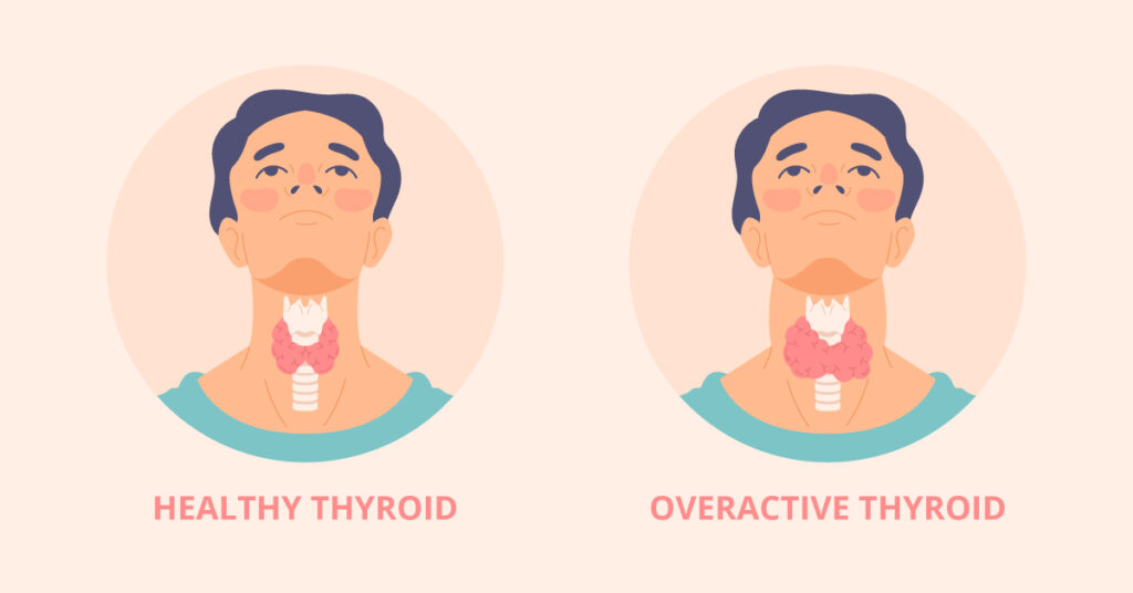 Hypothyroidism- An underactive Thyroid Gland