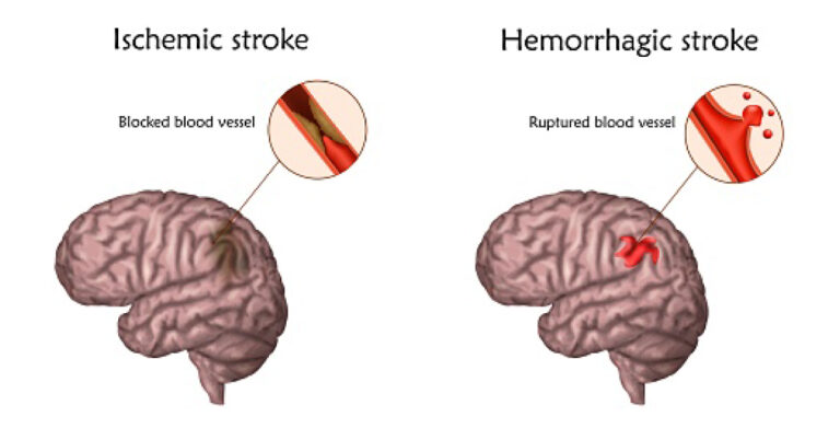 brain stroke