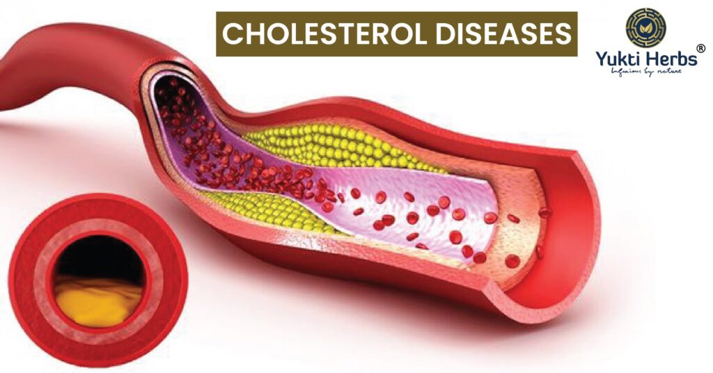Cholesterol – Herbal Remedies and Ayurvedic Treatment